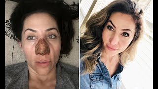 Woman who lived as a recluse after her nose DOUBLED in size due has the skin burned off