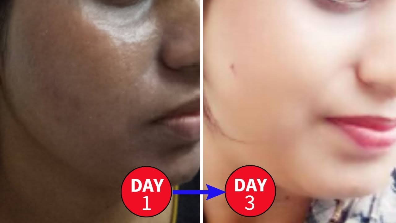 Skin Whitening Treatment 100% Working/Get Clear Skin Naturally In 3 Days| Skin  Whitening Home Remedy - Youtube