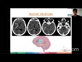 Basic Interpretation of the CT Brain