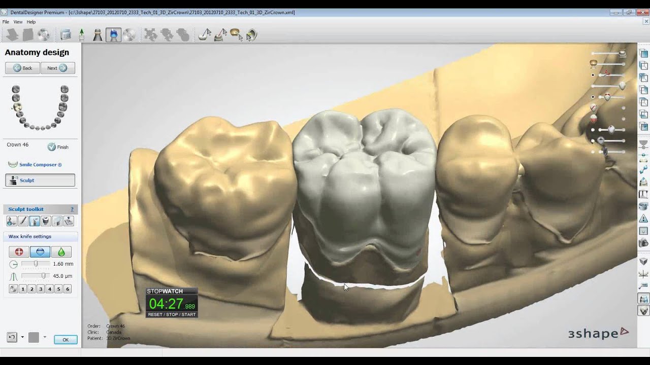3D ZirCrown Designed in 7mins 13secs