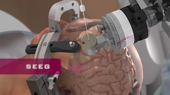 ROSA Brain 3D video | Unison Healthcare Group友信醫療集團 - 天天要聞