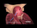 Surgery for Atrial Fibrillation at Harrison Medical Center