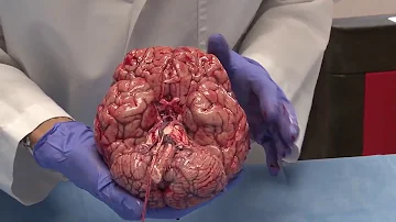 ¿Cómo se extrae un cerebro en la autopsia?