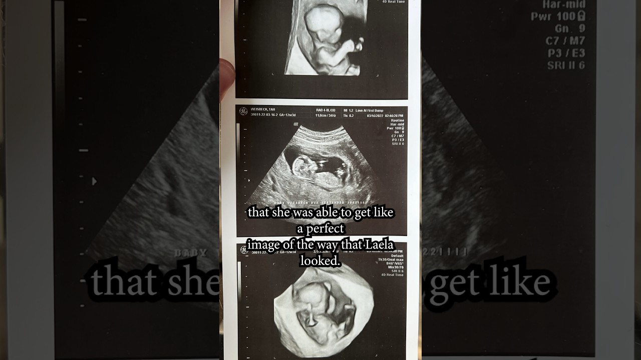Sonographer's Earliest Baby Gender Prediction. WE GUESSED WRONG 👶🏼