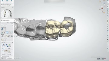 Design full #26,#27 on 3Shape Dental System -Team CadCam thiết kế răng