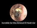 Incredible Ear Wax Removal Of Adult's Ear With Relaxing Piano Music