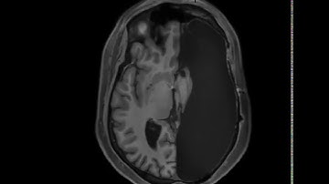 MRI Brain Scan With One Hemisphere Removed