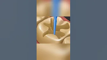 شاهد إزالة تسوس الاسنان والجير طبيعيا عند الطبيب أسرع طريقة لتخفيف ألم الأسنان أسباب وعلاج التسوس 