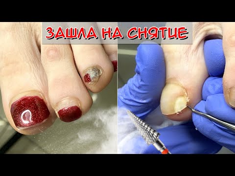Онихолизис ногтей / Синяк под ногтем на ноге