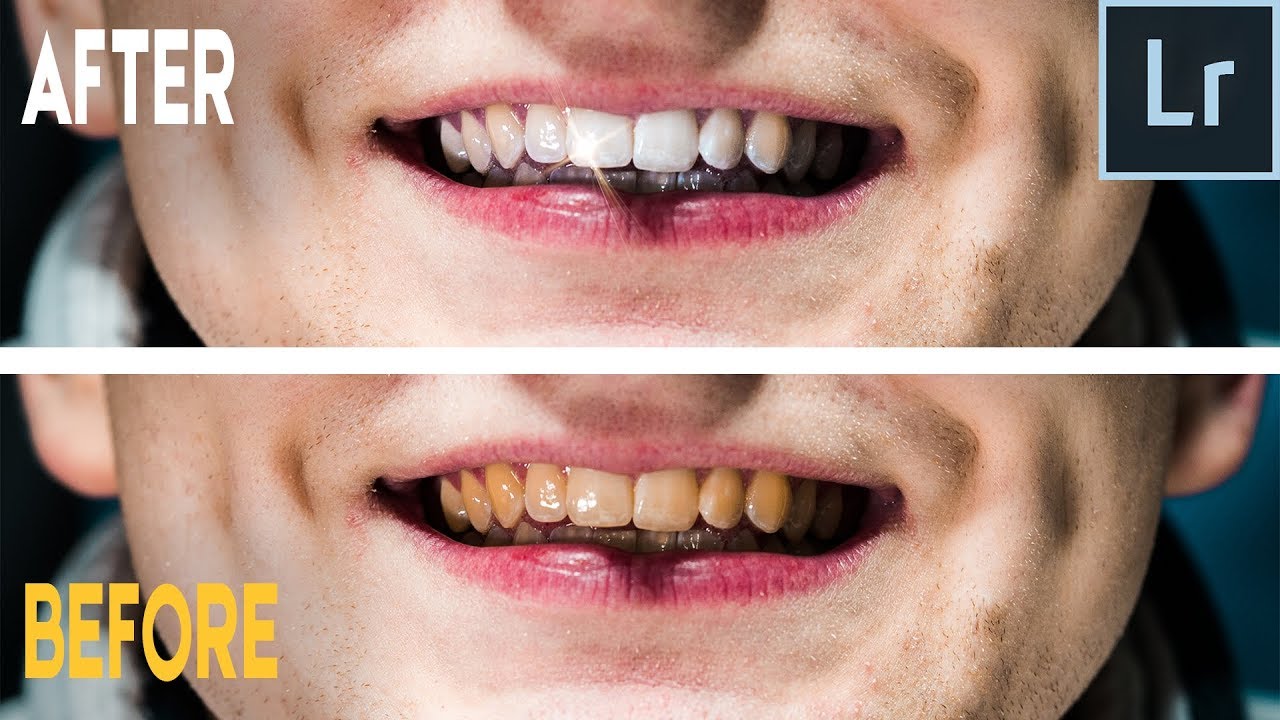 How To Whiten Teeth In Lightroom Mobile