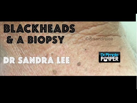 Blackhead & Whitehead Extractions And A Skin Biopsy