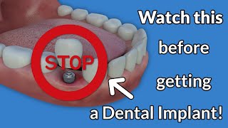 Stop! Watch this before getting Dental Implant