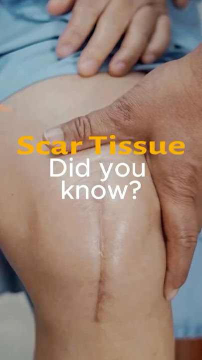 Did You Know Scar Tissue Can Be Internal AND External?