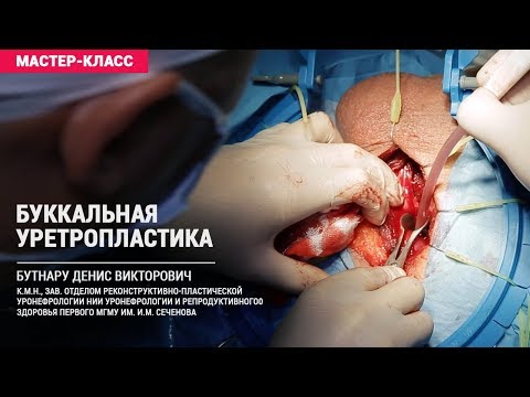 Видео: Дивертикул уретры: лечение, хирургия и восстановление