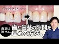 札幌市の歯医者「ユアーズデンタル クリニック」ブラックトライアングルの閉鎖方法