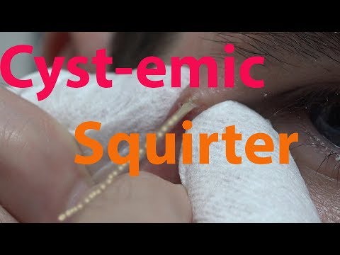 Cyst-emic Squirter | Life With Cystic Acne Documentary #