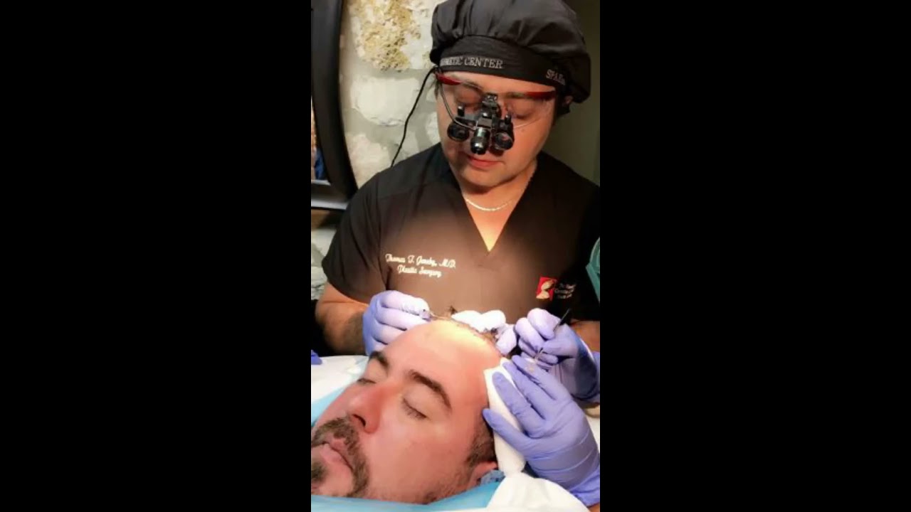 Best Neograft Hair Transplant in Texas ! San Antonio Dallas Austin