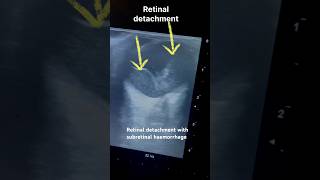 Download Lagu Retinal detachment. B-scan. Cricket ball hit on eye#radiology#cricket#eyes#sonography#opthalmology# MP3