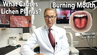 Lichen Planus - Burning Mouth Symptoms | Causes | Treatment