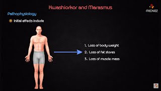 Kwashiorkor and marasmus - USMLE Biochemistry