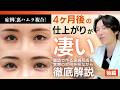 【症例解説】ヒアルロン酸卒業！？脂肪で作る涙袋形成を松浦医師が徹底解説！