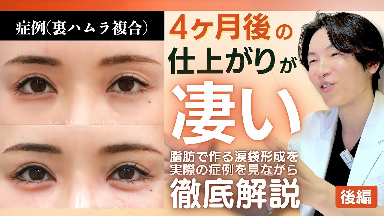 【症例解説】ヒアルロン酸卒業！？脂肪で作る涙袋形成を松浦医師が徹底解説！
