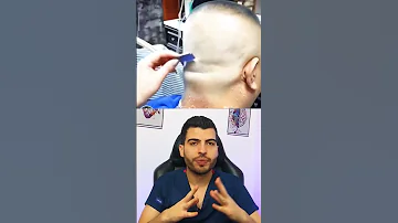 قشرة الشعر قشرة الشعر قشرة فطريات جلدية علاج فطريات حلاقة شامبو د مصعب حسوا ثقف نفسك طبيا 