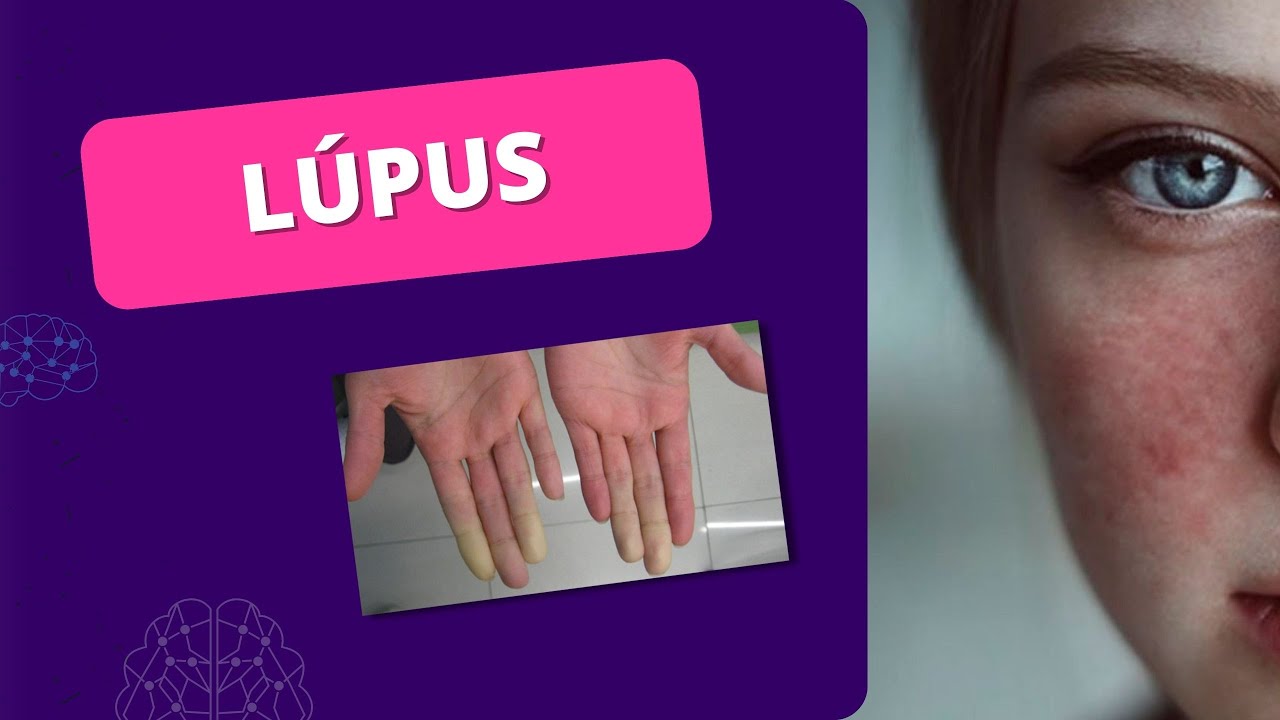 LÚPUS eritematoso sistêmico: sintomas e tratamento - importância do EXERCÍCIO TERAPÊUTICO