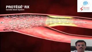 Carotid Stenting Technique