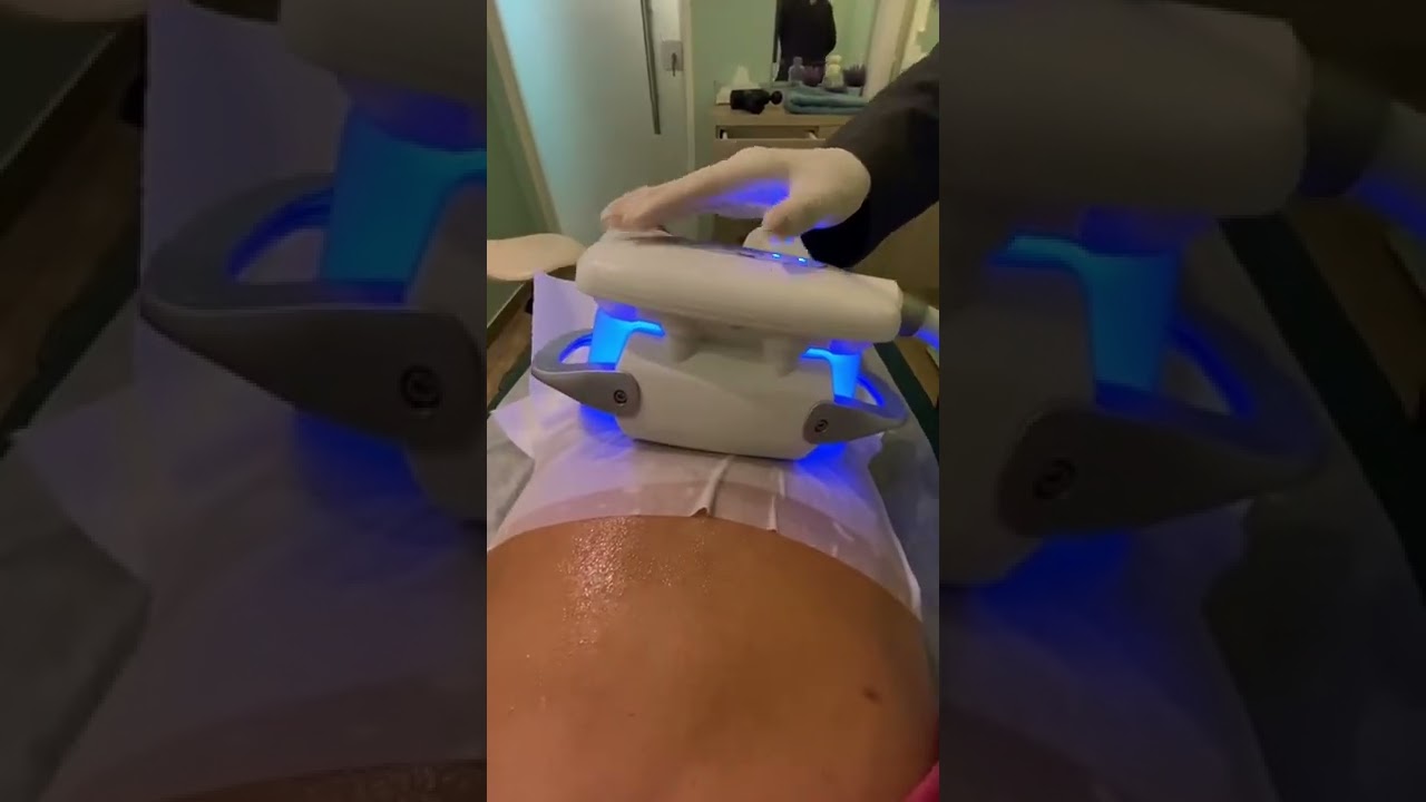 #Cryolipo