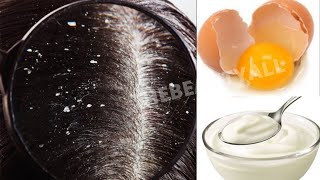 HOW TO TREAT DANDRUFF AT HOME ||  GET RID OF DRY SCALP AND DANDRUFF  || QUICK REMEDY FOR DANDRUFF