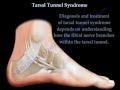 Tarsal Tunnel Syndrome - Everything You Need To Know - Dr. Nabil Ebraheim