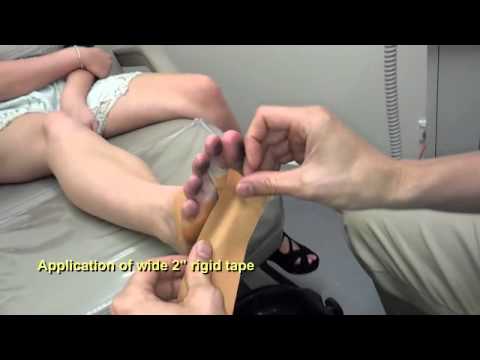 Steroid injection for plantar fasciitis technique