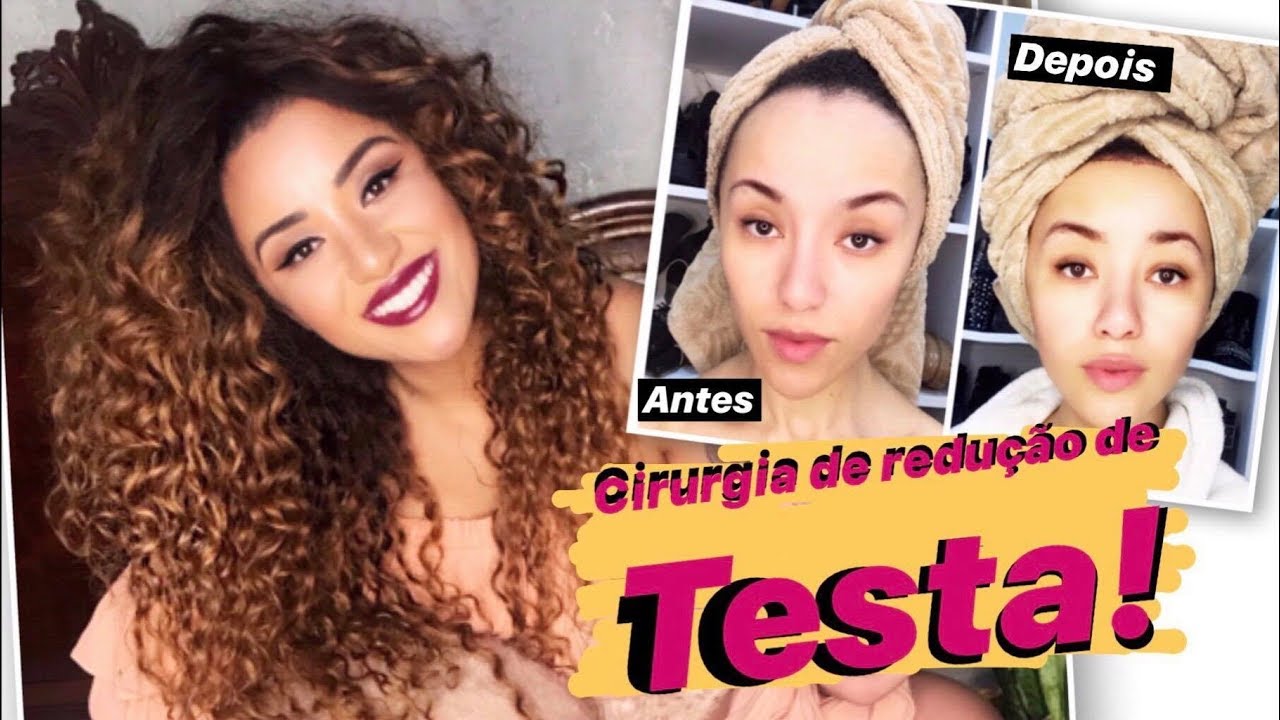 CIRURGIA DE REDUÇÃO DE TESTA - 1 ANO DEPOIS - YouTube