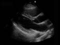 Heart PLAX Normal LT Ventricle Function