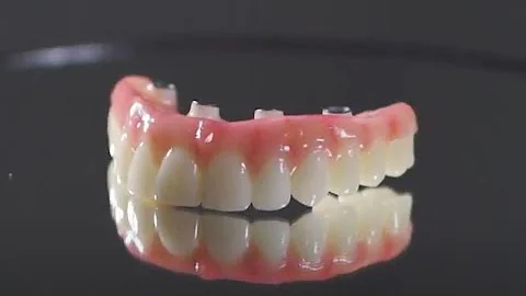 முழு வாய் பல் உள்வைப்புகள். நீங்கள் தெரிந்து கொள்ள வேண்டியவை மற்றும் விலை