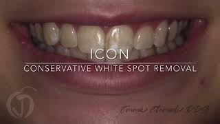 Icon White Spot Fluorosis Treatment