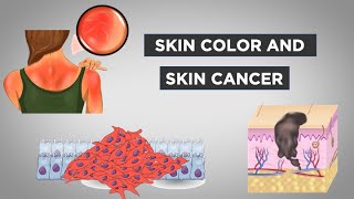 Evo-Ed: Skin Color and Skin Cancer