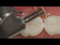 Resinas Compostas em Dentes Posteriores.  Parte 02 - Acabamento e Polimento