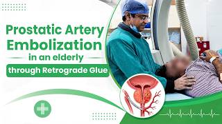 Prostatic Artery Embolization In An Elderly Through Retrograde Glue.