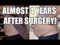 You Will Gain Weight Back After VSG - Gastric Sleeve Surgery! January 2021 Update!