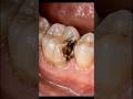 Hidden Cavity Between Teeth Removed 😱🦷 #shorts