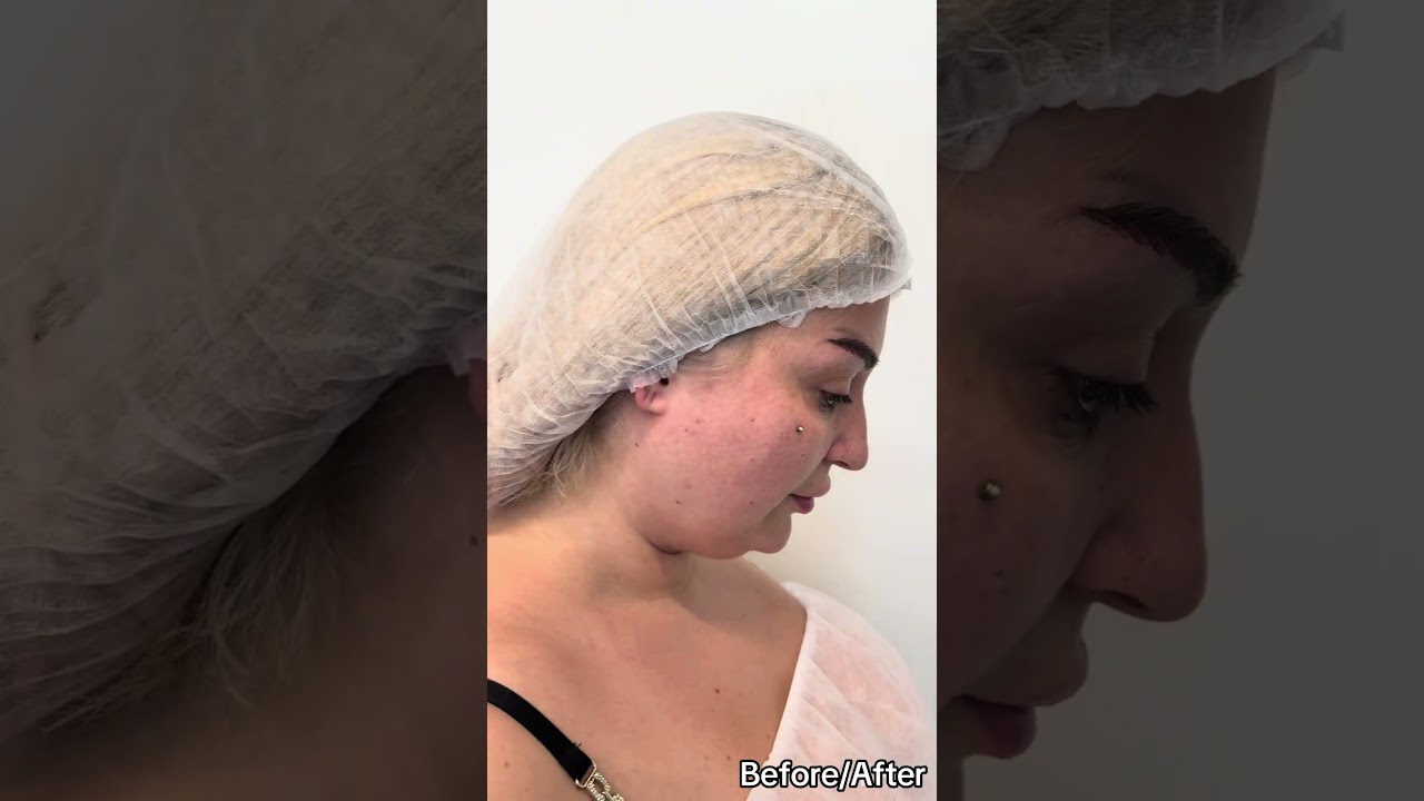 Buccal Fat Removal Transformation | Turkey Plastic Surgery Clinic, Istanbul