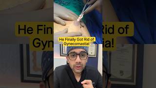 Gynecomastia Result On Suture Removal Day | Dr DC, Plastic Surgeon Pune, India #gynecomastiasurgery