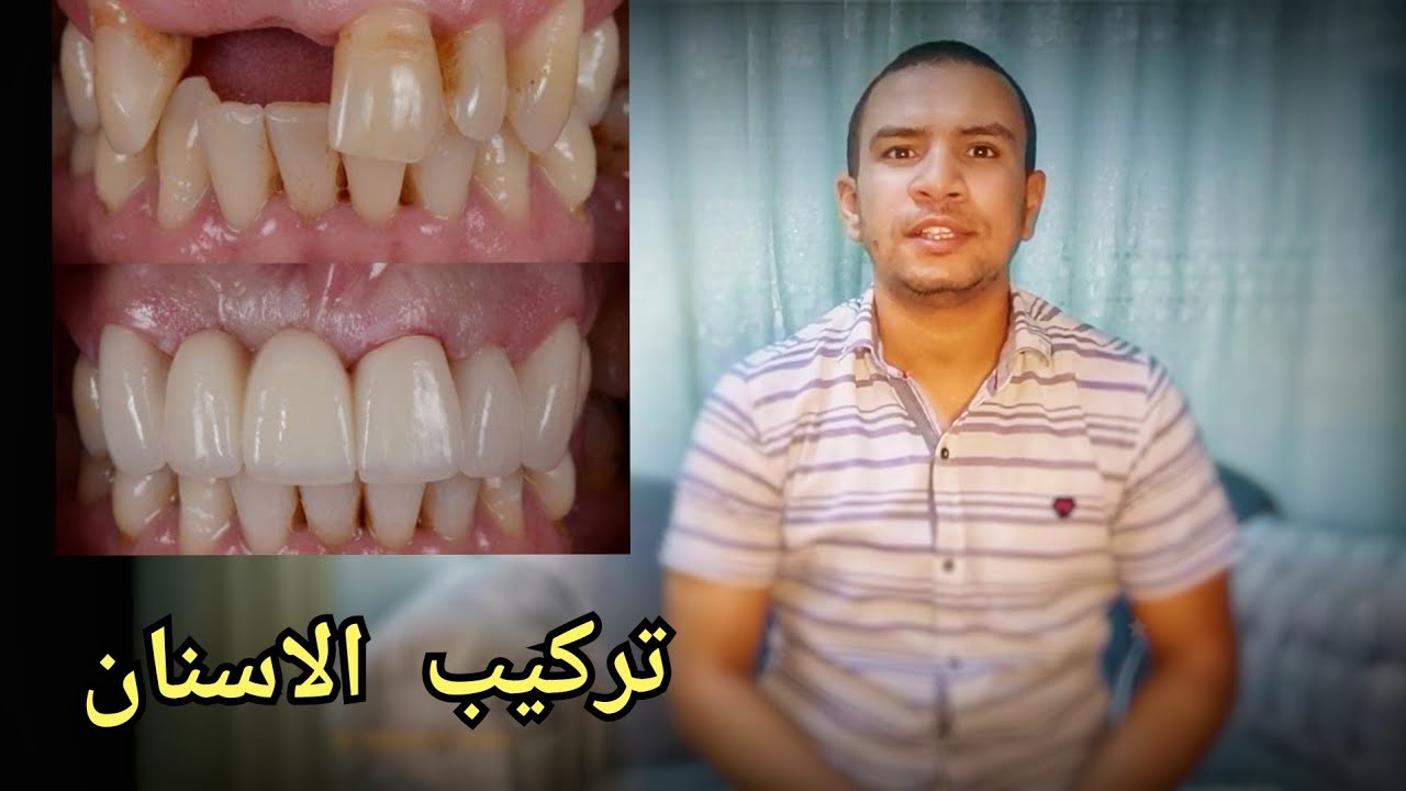 5 مشاكل شائعه جدا بعد تركيب الاسنان الثابته | متي يجب تغيير التركيبه