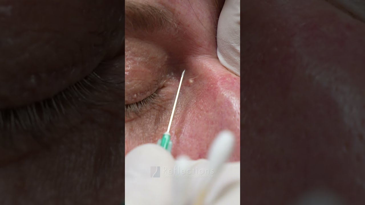 Milia Removal
