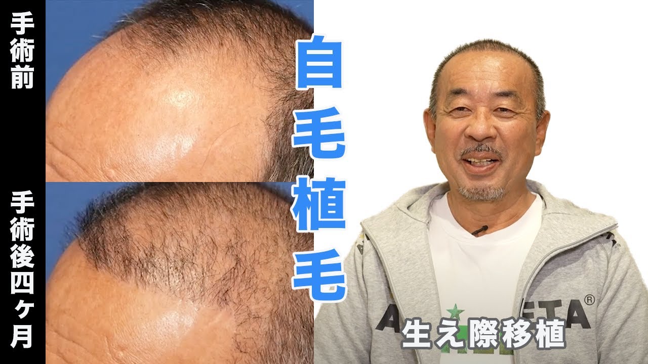 【中古】 育毛時代（続） 4 Months After Hair Transplant: Starting to Grow] 2,000 Grafts