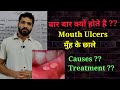 Mouth ulcers , Causes & Treatment ?? मुँह मे छाले होने के कारण ?