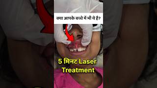 ऊपर का होंठ जुड़ा हुआ? Lip Tie कारण और Laser से इलाज #viral
