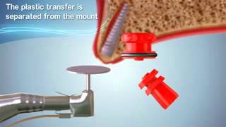 Cortex Saturn Implant